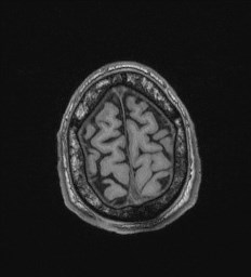 Cerebral toxoplasmosis (Radiopaedia 43956-47461 Axial T1 71).jpg