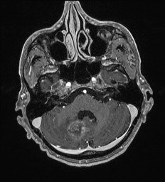 File:Cerebral toxoplasmosis (Radiopaedia 43956-47461 Axial T1 C+ 15).jpg