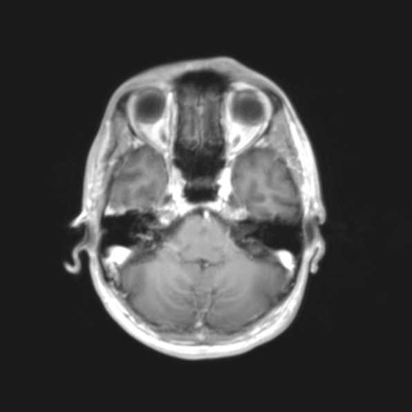 File:Cerebral toxoplasmosis (Radiopaedia 53993-61435 Axial T1 4).jpg