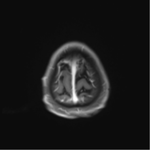 Cerebral toxoplasmosis (Radiopaedia 54575-60804 Axial T1 C+ 50).png