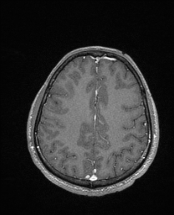 Cerebral toxoplasmosis (Radiopaedia 85779-101597 Axial T1 C+ 119).jpg