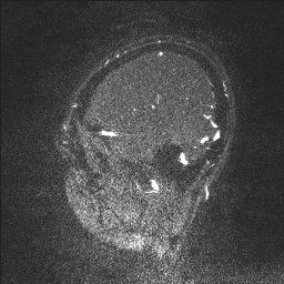 Cerebral tuberculosis with dural sinus invasion (Radiopaedia 60353-68090 Sagittal MRV 131).jpg