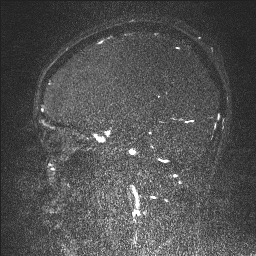 Cerebral tuberculosis with dural sinus invasion (Radiopaedia 60353-68090 Sagittal MRV 52).jpg
