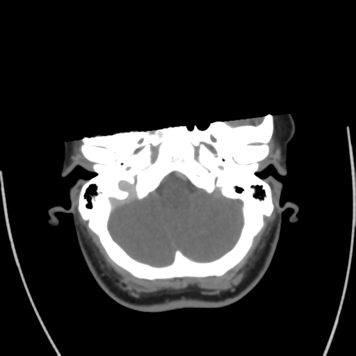 File:Cerebral venous infarct related to dural venous sinus thromboses (Radiopaedia 35292-36804 Axial C+ delayed 10).png