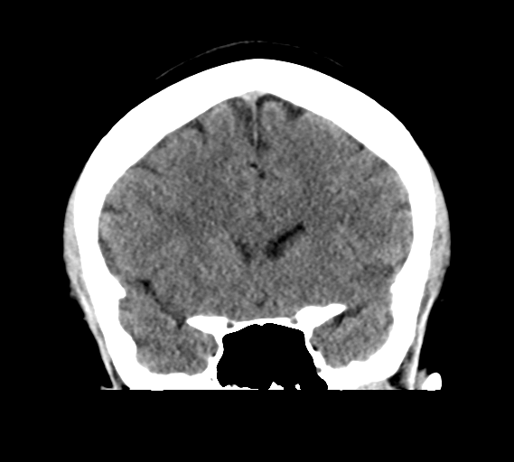 File:Cerebral venous infarct related to dural venous sinus thromboses (Radiopaedia 35292-36804 Coronal non-contrast 13).png