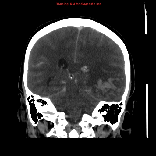 Cerebral venous infarction (Radiopaedia 12404-20735 B 51).jpg