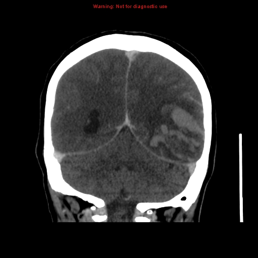 Cerebral venous infarction (Radiopaedia 12404-20735 B 59).jpg