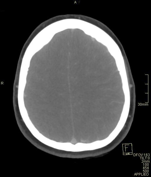Cerebral venous sinus thrombosis (Radiopaedia 91329-108965 Axial venogram 62).jpg