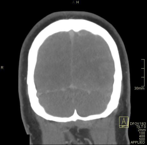 Cerebral venous sinus thrombosis (Radiopaedia 91329-108965 Coronal venogram 77).jpg