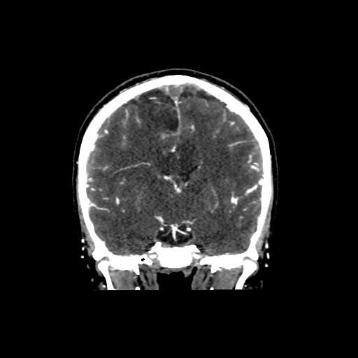 File:Cerebral venous throbmosis - hemorrhagic venous infarction (Radiopaedia 87318-103613 Coronal CT venogram 16).jpg