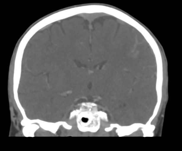 File:Cerebral venous thrombosis (Radiopaedia 38392-40467 Coronal CTA-Venogram 32).png