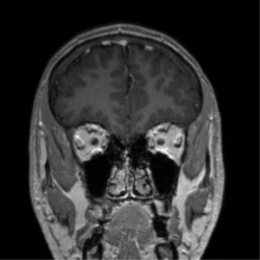 Cerebral venous thrombosis (Radiopaedia 38392-40469 Coronal T1 C+ 71).png