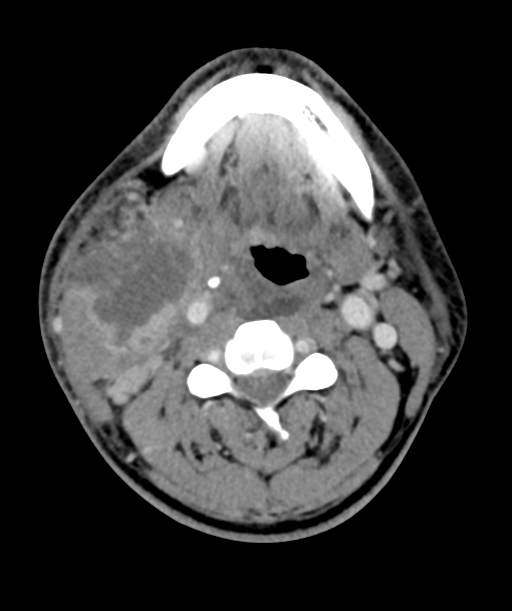 Cervical abscess (Radiopaedia 43725-47184 A 31).png