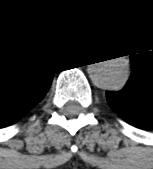 Cervical canal stenosis - OPLL and osteophytes (Radiopaedia 47329-51910 Axial non-contrast 85).png