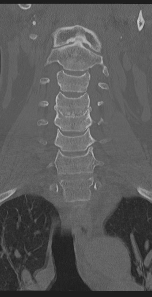 Cervical canal stenosis due to ossification of the posterior longitudinal ligament (Radiopaedia 47260-51823 Coronal bone window 20).png