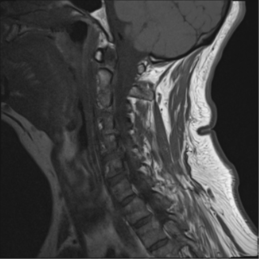 File:Cervical canal stenosis due to ossification of the posterior longitudinal ligament (Radiopaedia 47260-51824 Sagittal T1 5).png