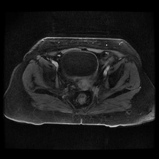 Cervical carcinoma (Radiopaedia 70924-81132 Axial T1 C+ fat sat 139).jpg