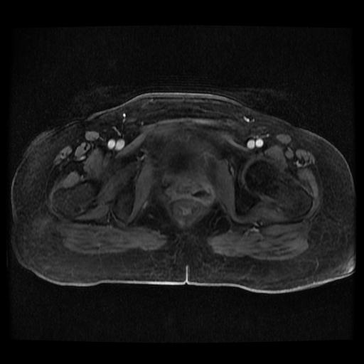 File:Cervical carcinoma (Radiopaedia 70924-81132 Axial T1 C+ fat sat 209).jpg