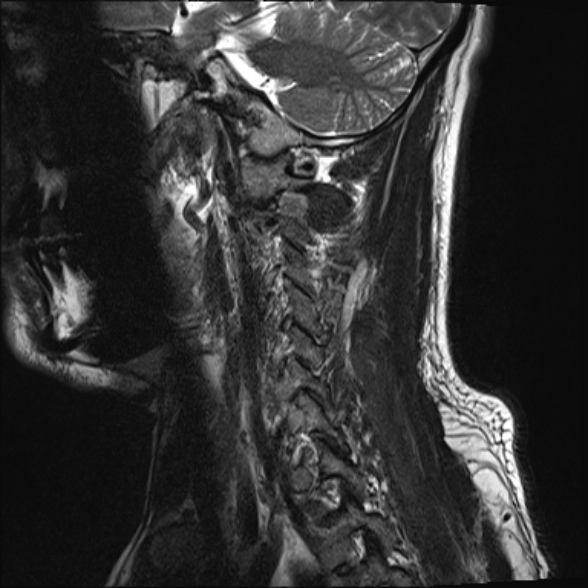File:Cervical disc extrusion (Radiopaedia 53950-60077 Sagittal T2 16).jpg