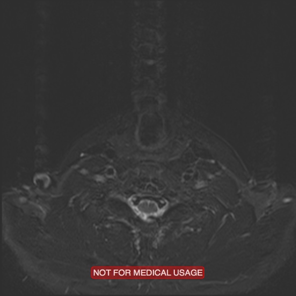 Cervical nerve schwannoma (Radiopaedia 27964-28221 C 41).jpg