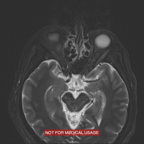 File:Cervical nerve schwannoma (Radiopaedia 27964-28221 C 9).jpg
