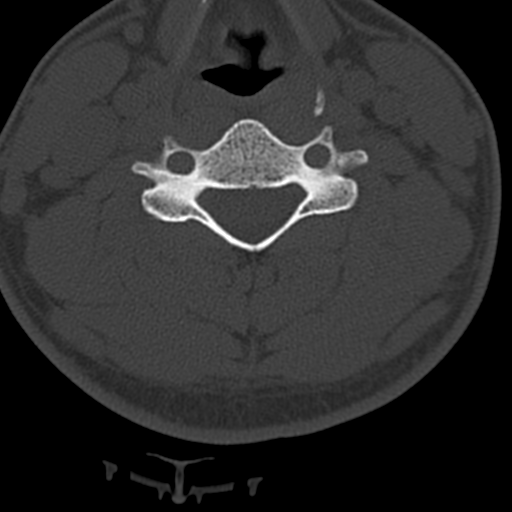Cervical schwannoma (Radiopaedia 57979-64974 Axial bone window 28).png