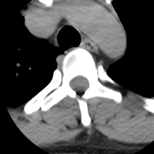 Cervical schwannoma (Radiopaedia 57979-64974 Axial non-contrast 73).png