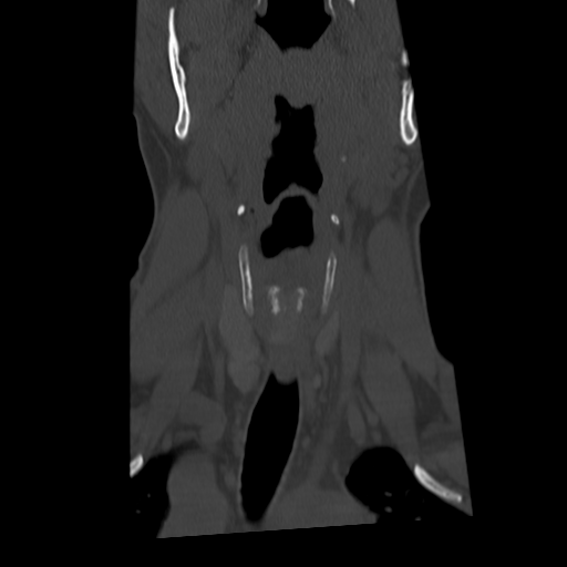 Cervical schwannoma (Radiopaedia 57979-64974 Coronal bone window 16).png