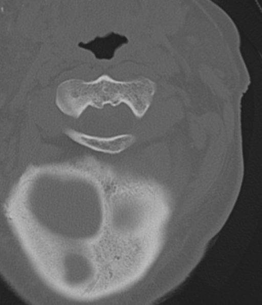 File:Cervical spine fracture in the setting of ankylosis (Radiopaedia 37038-38715 Axial bone window 17).png