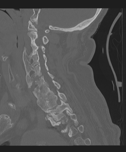 Cervical spine fracture in the setting of ankylosis (Radiopaedia 37038-38715 Sagittal bone window 33).png