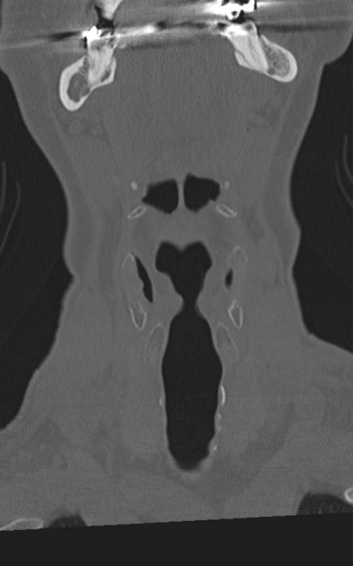 Cervical spine fractures with vertebral artery dissection (Radiopaedia 53296-59268 Coronal bone window 3).png