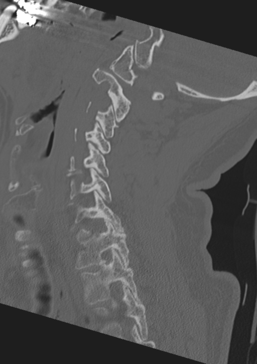 Cervical spine fractures with vertebral artery dissection (Radiopaedia 53296-59268 Sagittal bone window 24).png
