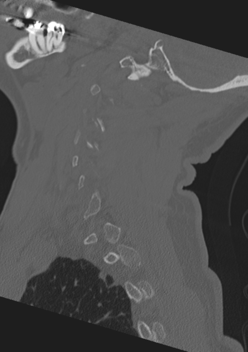 Cervical spine fractures with vertebral artery dissection (Radiopaedia 53296-59268 Sagittal bone window 54).png