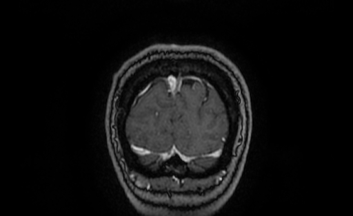 Cervical spondylodiscitis and calvarial hemangioma (Radiopaedia 64317-73103 Coronal T1 C+ 70).jpg