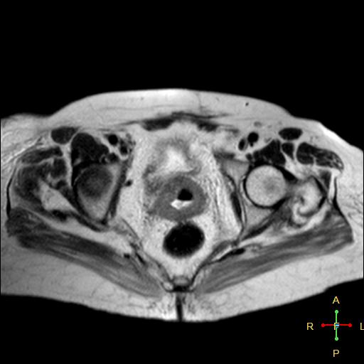 File:Cervical stump squamous cell carcinoma (Radiopaedia 48049-52858 Axial T2 4).jpg
