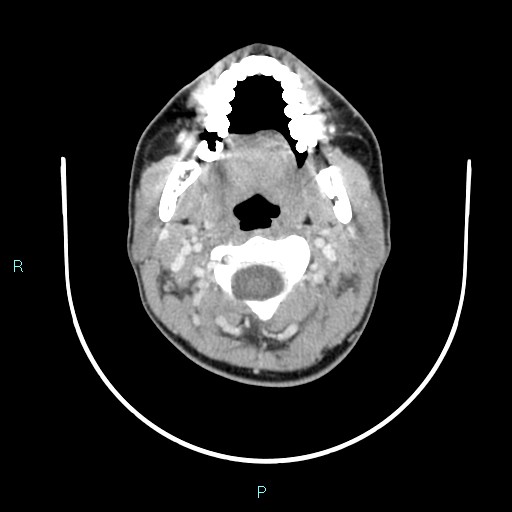 Cervical thymic cyst (Radiopaedia 88632-105335 C 87).jpg