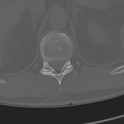 Chance fracture (Radiopaedia 33854-35020 Axial bone window 83).png