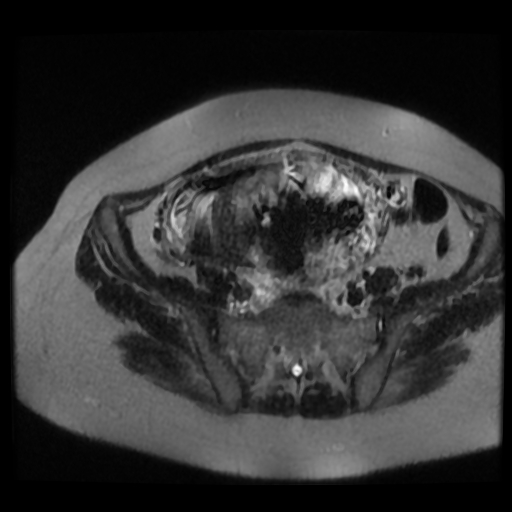 Chiari II malformation - fetal MRI (Radiopaedia 68099-77581 Axial T2-SSFSE 37).jpg