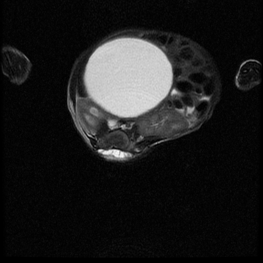 File:Chiari II malformation with spinal meningomyelocele (Radiopaedia 23550-23652 Axial T2 13).jpg