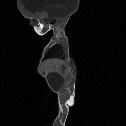 File:Chiari II malformation with spinal meningomyelocele (Radiopaedia 23550-23652 Sagittal T1 10).jpg