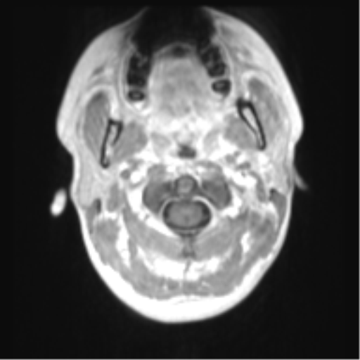 File:Chiari I malformation and obstructive hydrocephalus (Radiopaedia 41185-43978 Axial T1 C+ 2).png