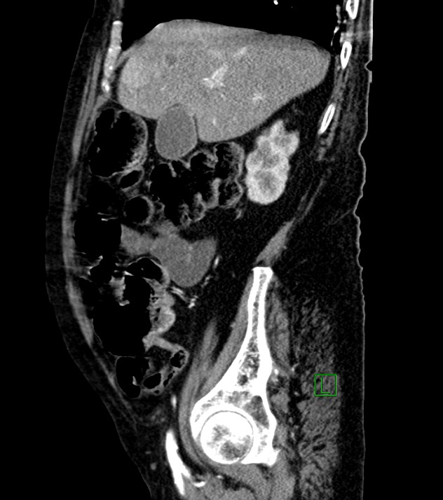 Cholangiocarcinoma with cerebral metastases (Radiopaedia 83519-98629 F 88).jpg