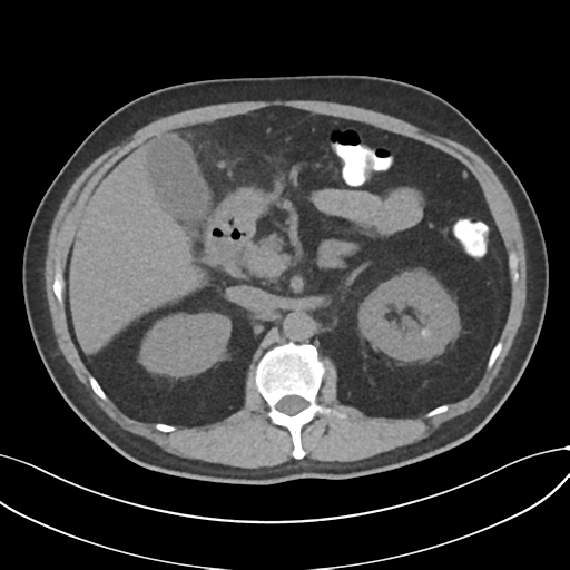 File:Cholecystitis with focal perforation and hepatic abscess (Radiopaedia 37189-38945 Axial non-contrast 30).png