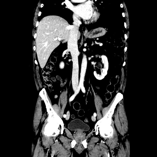 Choledocholiathiasis with normal caliber common bile duct (Radiopaedia 75368-86632 Coronal liver window 67).jpg