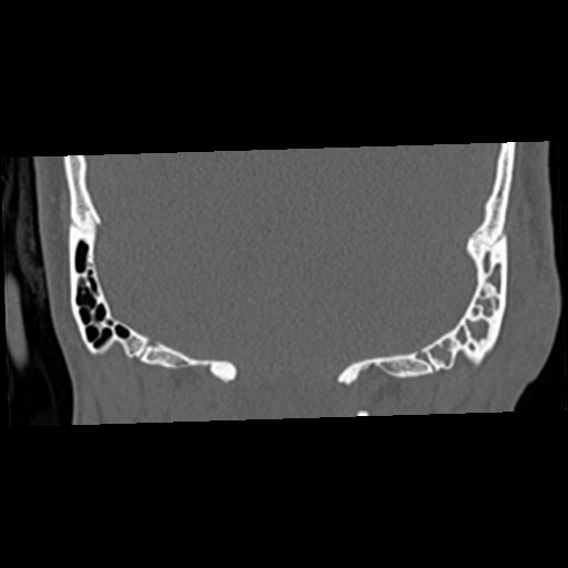 Cholesteatoma (Radiopaedia 84960-100474 Coronal bone window 57).jpg