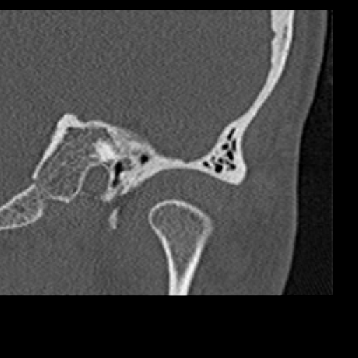 File:Cholesteatoma of the external ear (Radiopaedia 16540-16225 Coronal bone window 3).jpg