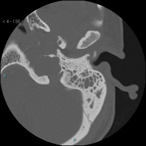 File:Cholesterol granuloma of the petrous apex (Radiopaedia 64358-73141 Axial bone window 65).jpg