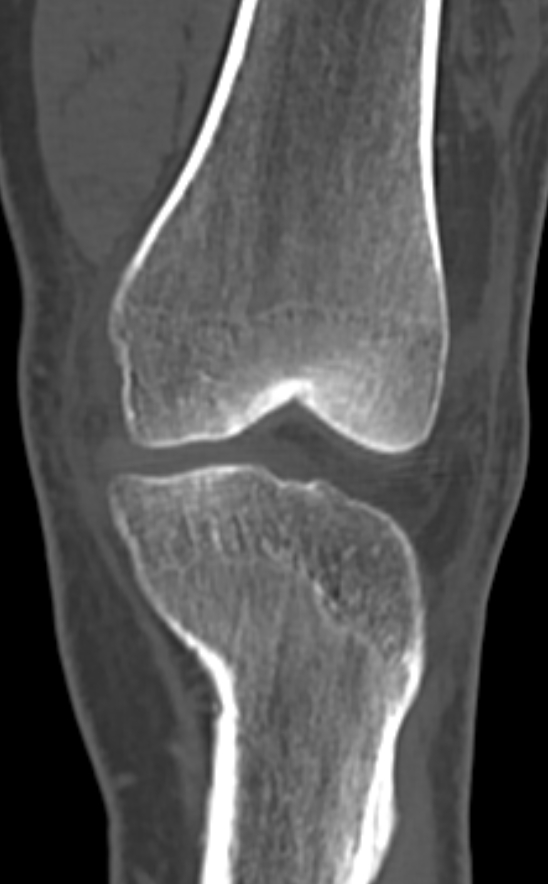 Chondrocalcinosis (Radiopaedia 82862-97173 Coronal bone window 29).jpg