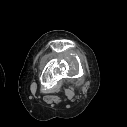 File:Chondrosarcoma - femur (Radiopaedia 64187-72954 Axial non-contrast 39).jpg