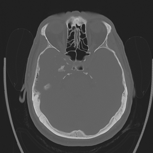 File:Chondrosarcoma of skull base- grade II (Radiopaedia 40948-43653 Axial bone window 15).png